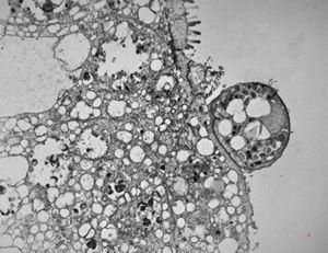 M,33y. | microsporidiosis (or cryptosporidiosis) - duodenum-posttransplantation immunodeficiency